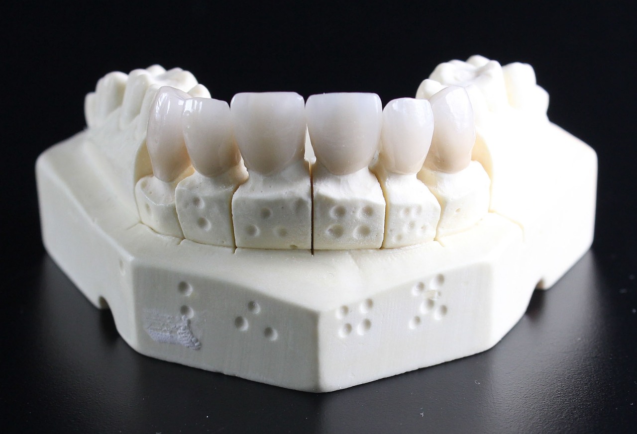 Jakie zalety mają koronki na zęby?