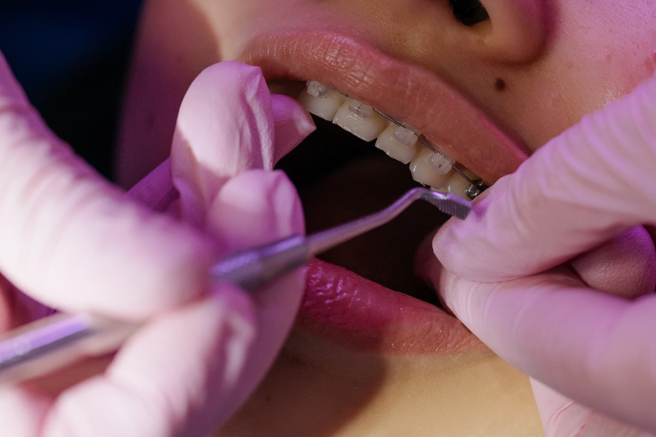 Jakie zalety mają ortodontyczne aparaty stałe?